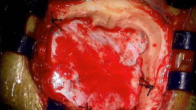 Krvavé a úžasné: Tak vypadá operace mozku v přímém přenosu