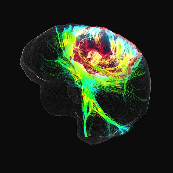 OPERACE Snímky mozku jednoho z Fortinových pacientů ukázaly, že tumor (červeně zbarvený, nahoře) prorostl do oblasti, která řídí pohyby rukou a nohou. 