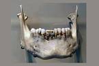 Zubní protéza ve Starém Egyptě