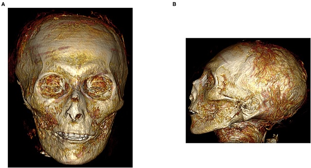 Trojrozměrný CT snímek digitálně rozbalené tváře levého profilu obličeje Amenhotepa I.