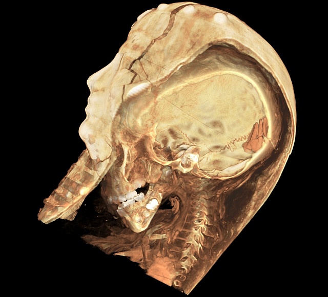 CT sken prozradil nezvyklý tvar hlavy krále Tutanchamona.