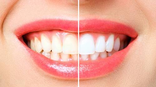Bílé zuby domácí metodou