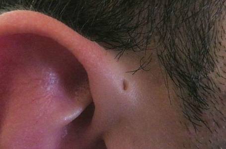 Záhadná dutinka u ucha