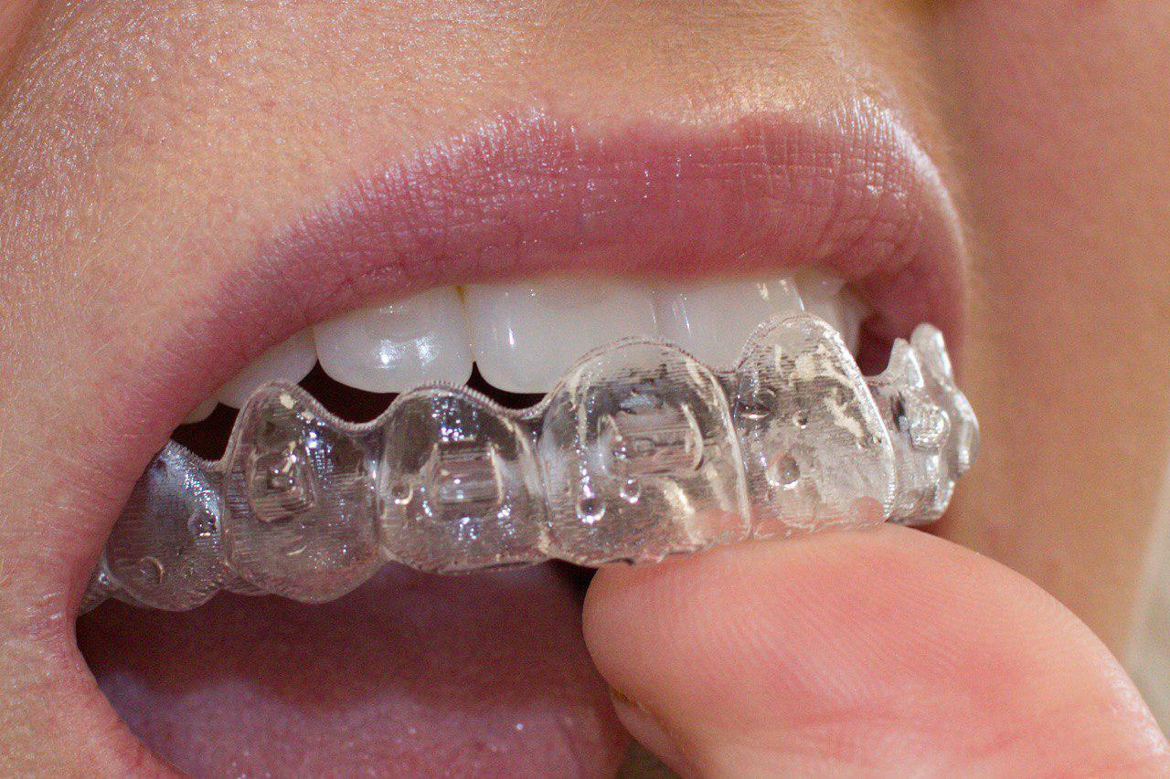 Srovnat zuby vám může pomoci i 3D tiskárna, nikdo nic… | Kafe.cz