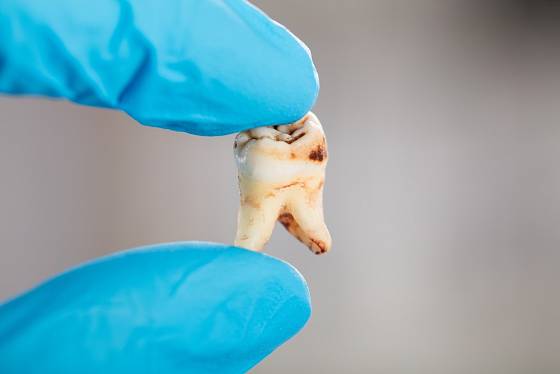 Zubař ukazuje zkažený zub.