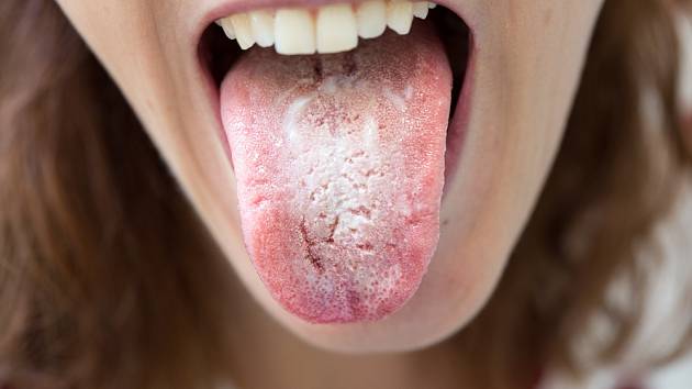 Bílý povlak na jazyku může signalizovat kvasinkovou infekci