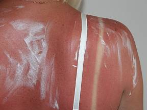 Každý z nás už někdy zažil, jak bolí spálená kůže od sluníčka.