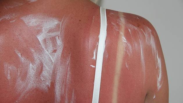 Každý z nás už někdy zažil, jak bolí spálená kůže od sluníčka.