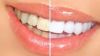 Bílé zuby působí zdravějším dojmem.