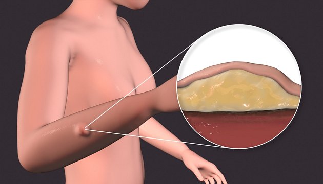 Jak zlikvidovat nevzhledné tukové bulky běžnými věcmi z kuchyně? |  iReceptář.cz