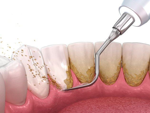 Ústní hygiena: škálování a kořenové hoblování (konvenční periodontální terapie). Lékařsky přesná 3D ilustrace léčby lidských zubů.
