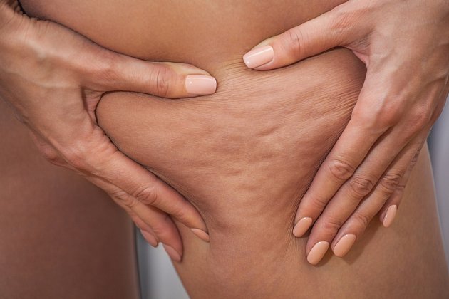 Celulitida se nejčastěji projevuje hrbolatou pokožkou na stehnech.