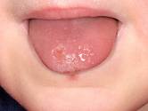 Afty patří k nejznámějším zánětlivým onemocněním ústní sliznice postihujícím zhruba čtvrtinu populace vyspělých zemí.