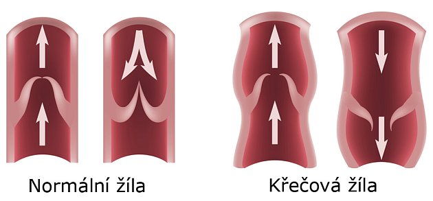 Priessnitzův zábal krok za krokem nejen proti křečovým žilám | iReceptář.cz