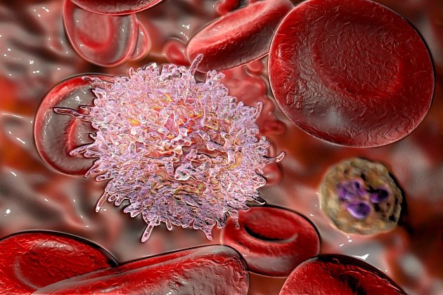 Vlasatobuněčná leukémie, 3D ilustrace. Jedná se o hematologickou malignitu, chronickou lymfocytární leukemii, s akumulací abnormálních B lymfocytů.