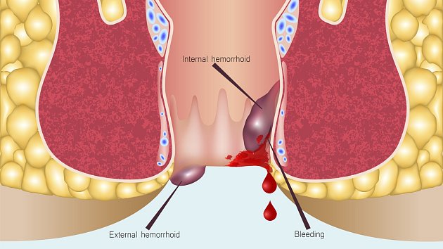Hemeroidy jsou častou chorobou, která trápí více než 50 % populace nad 50 let.