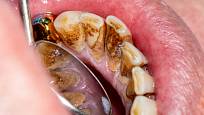 Zuby je třeba důkladně čistit i z vnitřní strany.