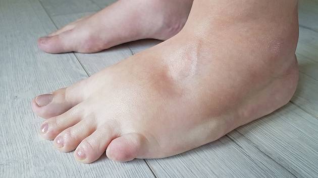 Otoky nohou mohou mít celou řadu závažných příčin.