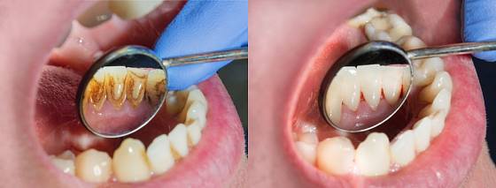 Zubní kámen - před a po odborném vyčištění.