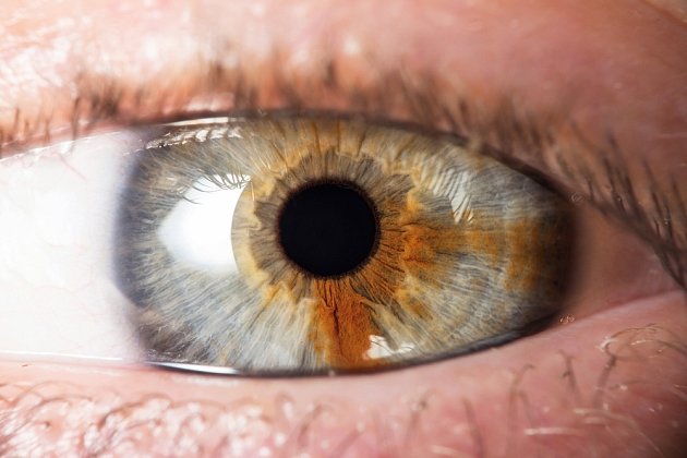 Zbarvení oční duhovky nebývá vždy pravidelné.