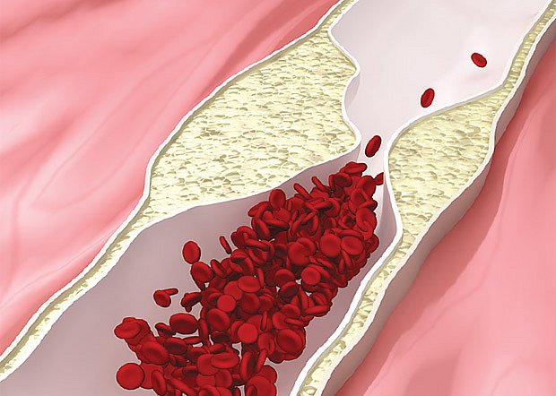 cholesterol ucpává cévy