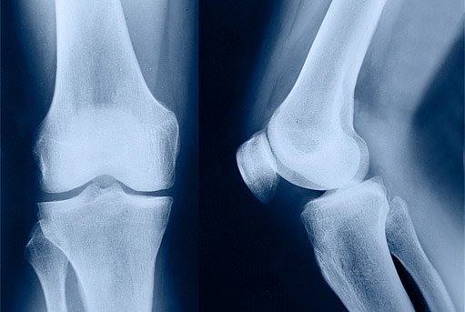 ameliorează durerea articulației genunchiului cu artroză