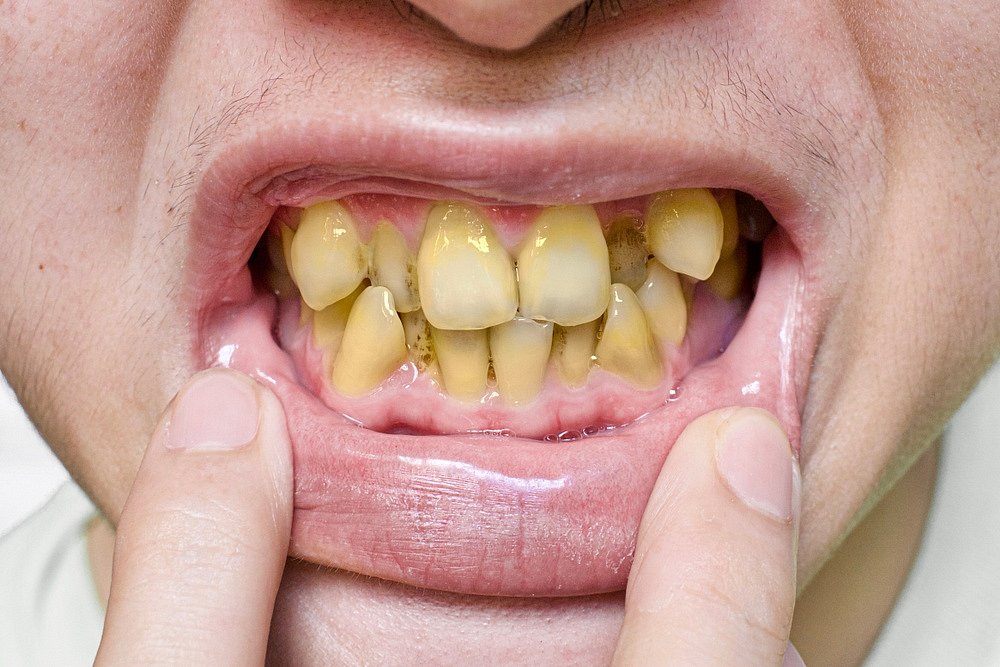 Bílé zuby přírodní metodou: Které běžné potraviny bělí zuby… | iReceptář.cz