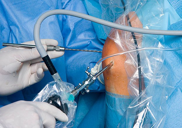 artroskopická operace kolene
