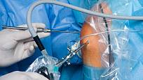 artroskopická operace kolene