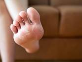 Zpocené nohy jsou ideálním útočištěm pro plísně a bakterie
