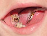 Čím déle návštěvu zubaře odkládáme, tím více se nám může zubní kaz vymstít.