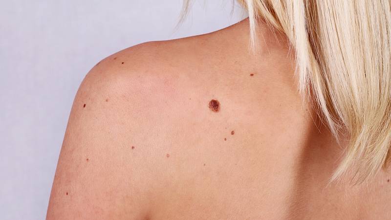Vyšetřením znamének můžeme předejít rakovině kůže