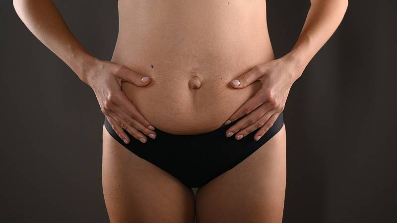 Diastáza – nejčastější problém žen po porodu