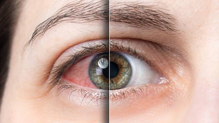 Červené oči značí únavu. Mohou však indikovat i akutní onemocnění
