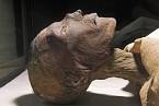 Mumie Ramesse V., je patrné, že měl neštovice.
