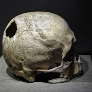 Lebka s otvorem po trepanaci z 2.-3. tisíciletí př. n. l.