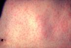 Spalničky jsou vysoce nakažlivé infekční onemocnění. Po zhruba 4 dnech se objeví vyrážka v podobě malých skvrnek, které se postupně mění z červené na hnědočervenou.