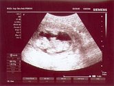  LIDSKÝ ZÁRODEK. Pouze do dvanácti týdnů těhotenství je možné zdravé matce provést interrupci. Později pouze ze zdravotních důvodů. Na ultrazvukovém snímku je třináctitýdenní plod. 
