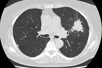 Včasné odhalení nádoru na plicích je důležité. Ilustrační foto.