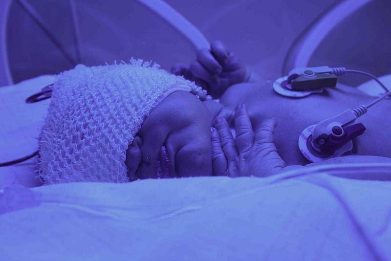 Malý Jaroušek má novorozeneckou žloutenku, a tak musí být pod modrým světlem