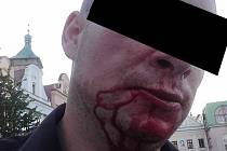 Takto dopadl v sobotu ráno muž z Havlíčkova Brodu, který byl napaden skupinkou cizinců v havlíčkobrodské Žižkově ulici. 