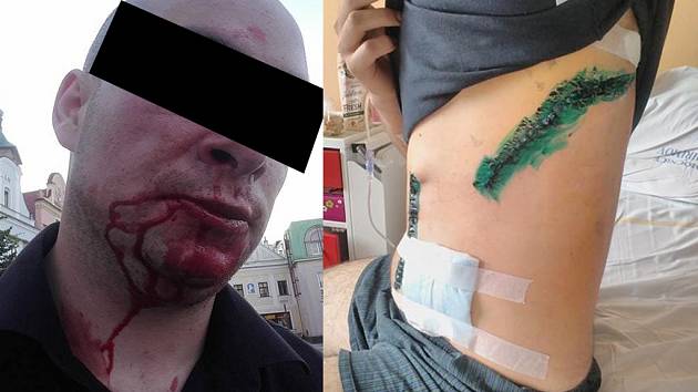 Na snímku vpravo je vidět, jak dopadl mladík, kterého jeden z Rumunů napadl 25. června v Humpolci. Na levém snímku je muž z Havlíčkova Brodu, který byl zraněn skupinkou cizinců v sobotu 2. července v havlíčkobrodské Žižkově ulici.