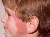 Erysipel neboli růže je relativně časté akutní infekční onemocnění kůže a podkoží provázené celkovými příznaky
