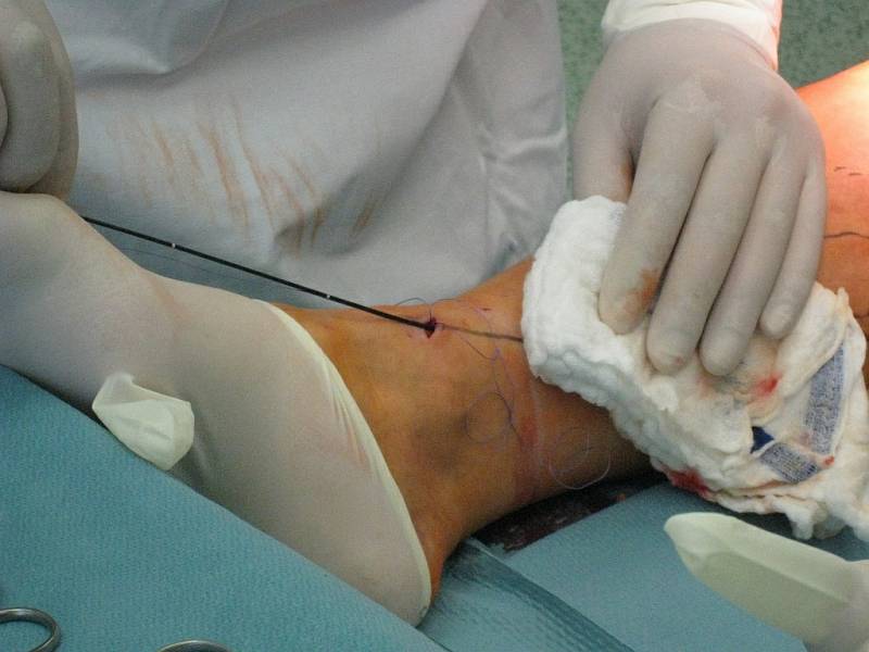 Dvě jizvičky zůstanou po operaci křečových žil „mikrovlnkou“.