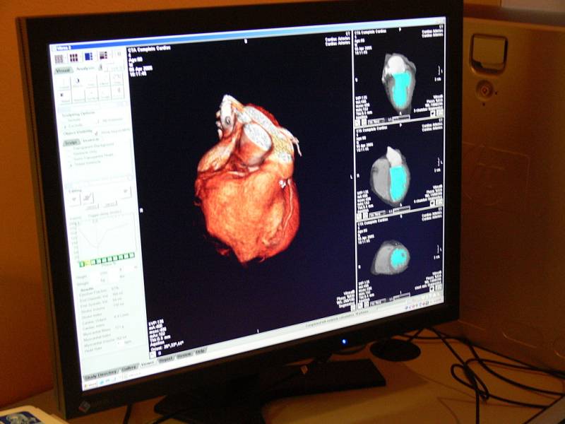 LÉKAŘI  V LITOMYŠLSKÉ NEMOCNICI  získali  nový přístroj CT, který umožní přesnější  a detailnější vyšetření orgánů nemocného člověka.