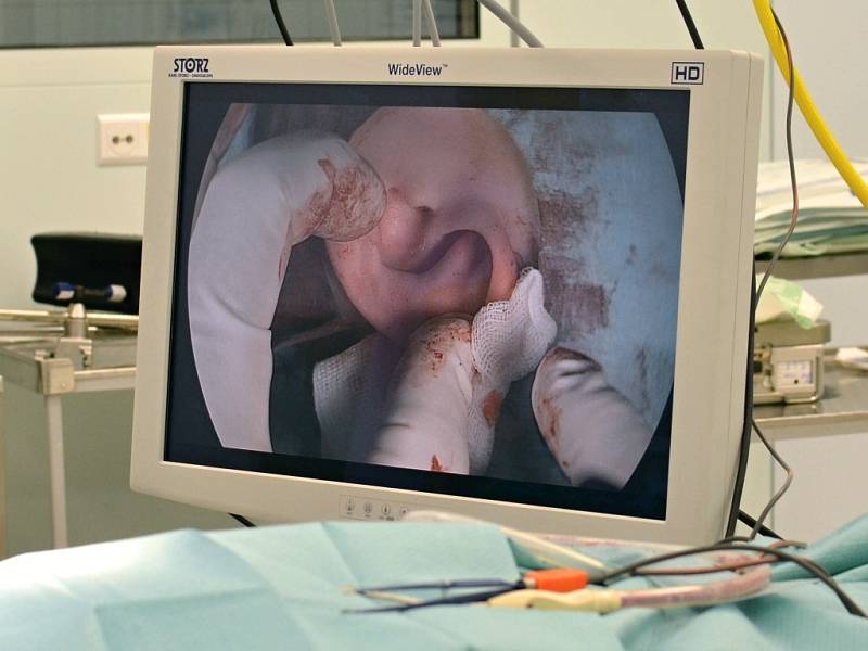 Plastické operace ušních boltců ve svitavské nemocnici za přítomnosti kamery