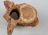 Projevy difuzní idiopatické hyperostózy skeletu (DISH) na kostnicovém materiálu z Bělé pod Bezdězem z roku 2014.