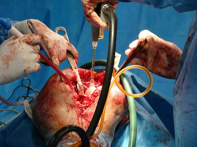 Výměna poškozeného kolenního kloubu za endoprotézu.