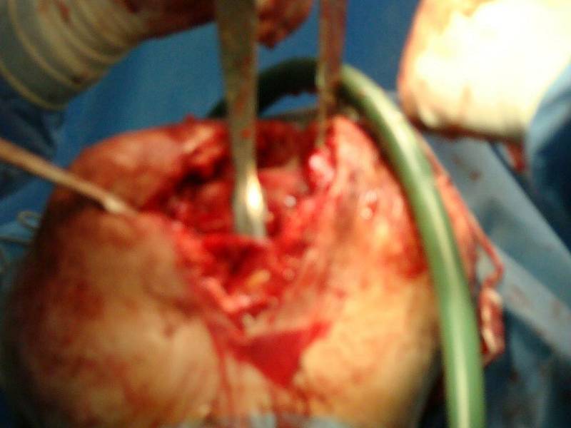 Výměna poškozeného kolenního kloubu za endoprotézu.