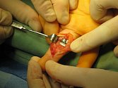 Nejmodernější typ kloubního implantátu prstu na ruce voperovali ortopedové v novoměstské nemocnici ženě ze Žďárska. 